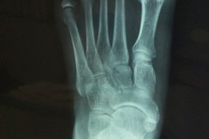 What is a Foot Fracture?