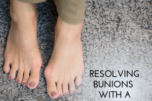Resolving Bunions With A Bunionectomy