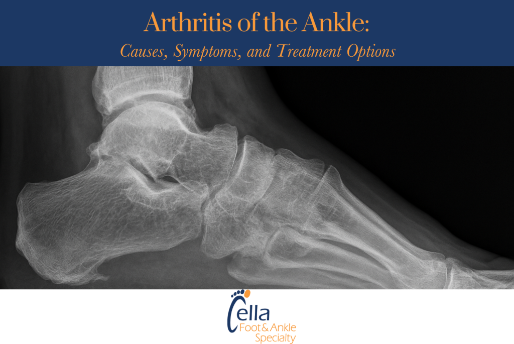 Arthritis of the Ankle Causes, Symptoms, and Treatment Options